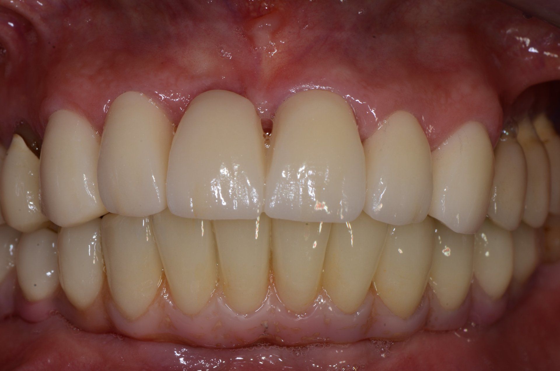 primo piano di denti paziente 10