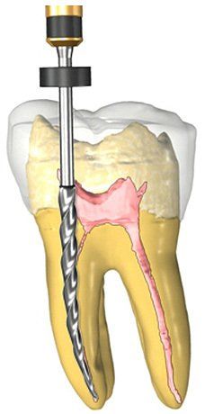root canal