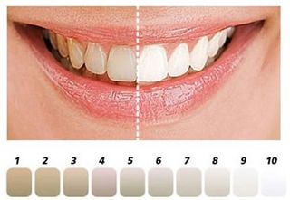 porcelain veneers