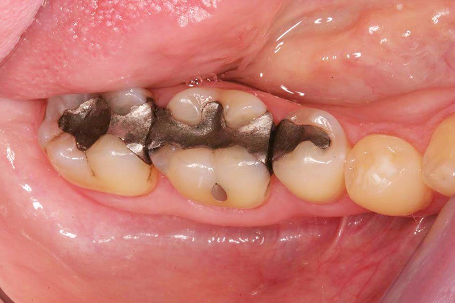 Dental Fillings Before