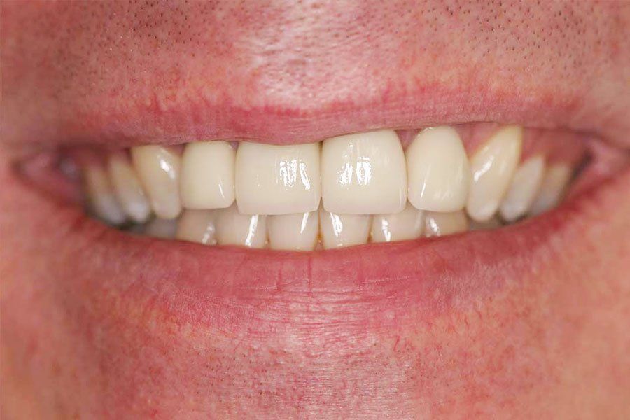 Porcelain Bridge After