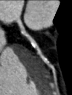 CT image showing plaque