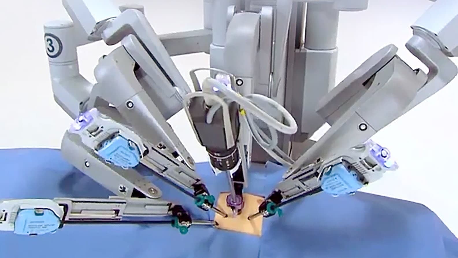 Ilustração da tecnologia de cirurgia robótica utilizada em procedimentos cirúrgicos.
