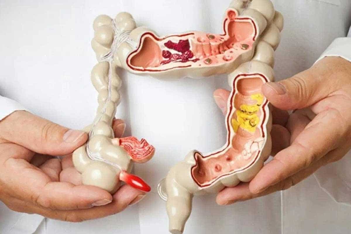 Um médico segurando um modelo de resina explicativo demonstrando o intestino grosso com diversas enfermidades do intestino grosso