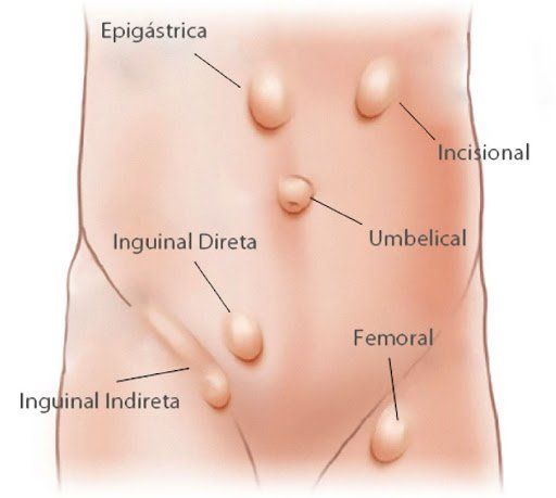 Ilustração dos tipos de hérnia da parede abdominal: epigástrica, incisional, inguinal direta, umbilical e femoral