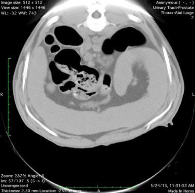 Cross-sectional CT scan of abdomen. Hollow, gas-filled bowel loops are visible.