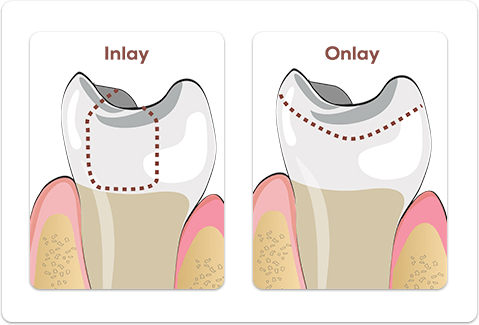 Tooth Colored Fillings - Christiana Pleasant Dental