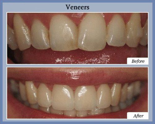 veneers+v2.jpg