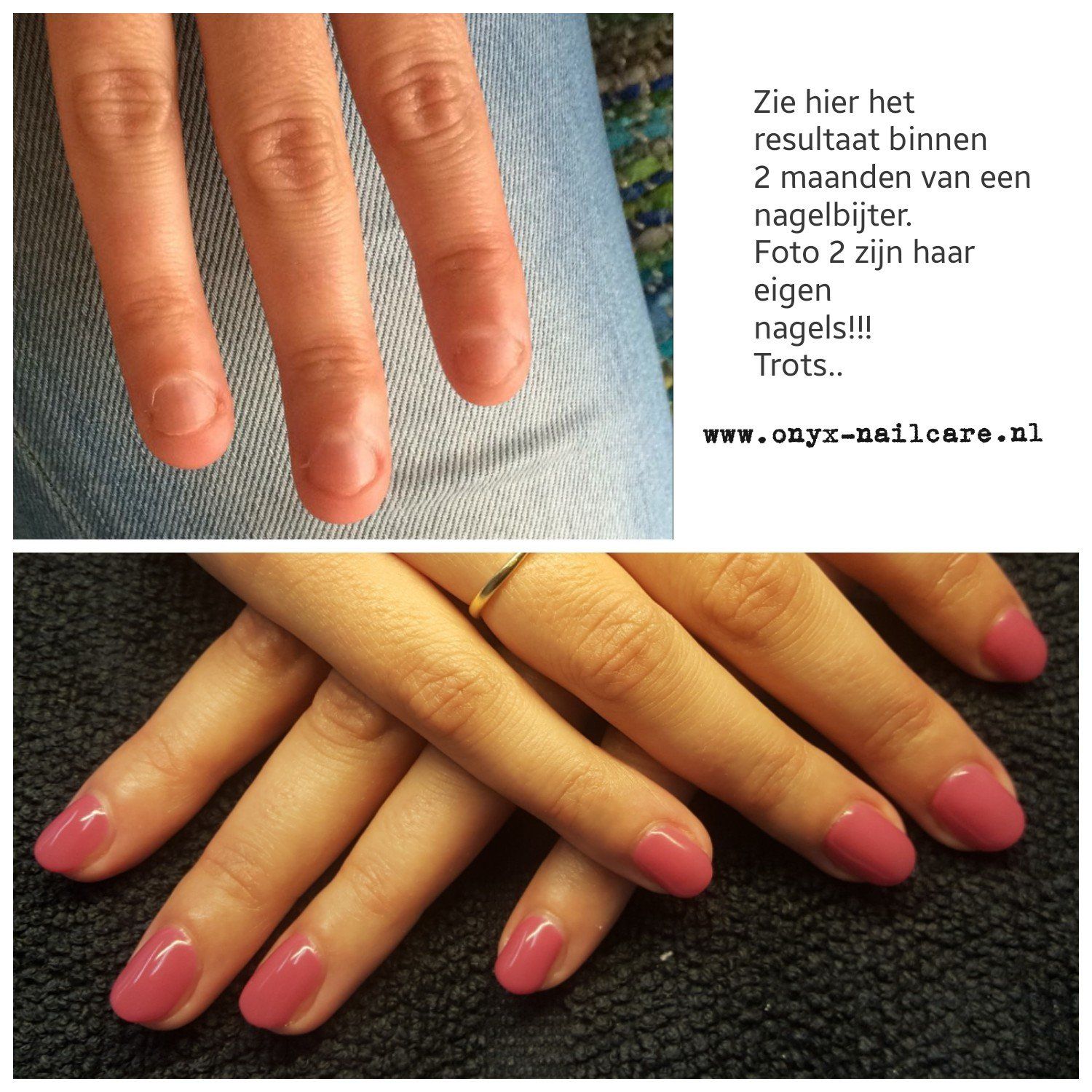 Nagelbijter