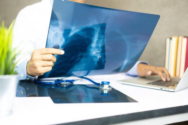 TB Test requirement for UK Spouse Visa