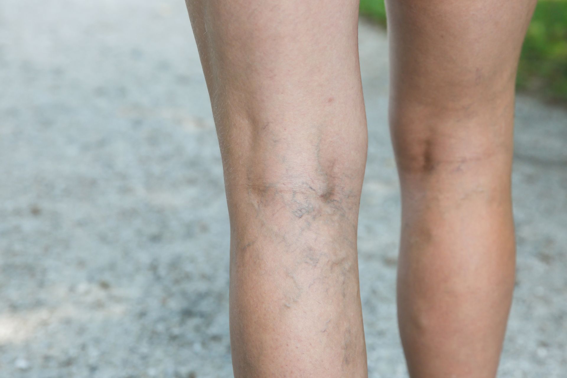 Alaska Vein Care