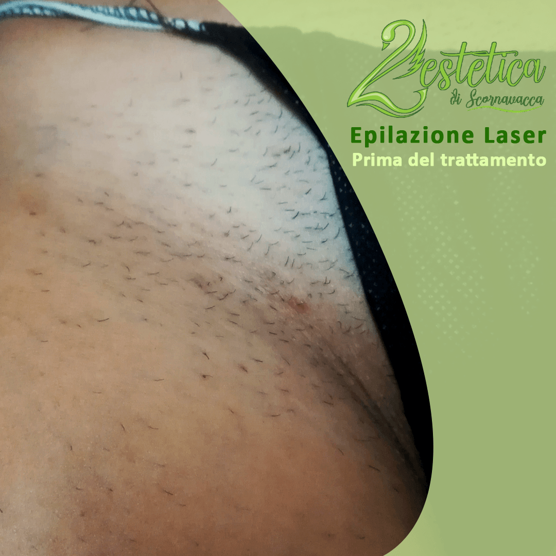 epilazione laser inguine
