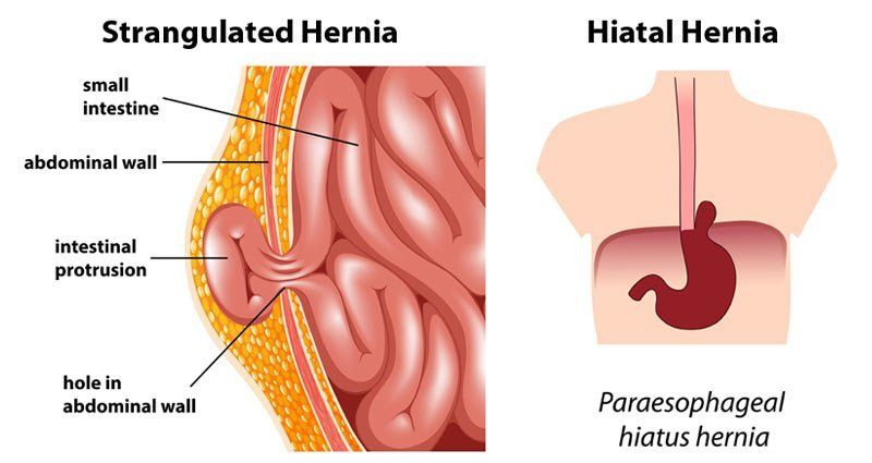 Massage Therapy for Hernias Nassau County NY