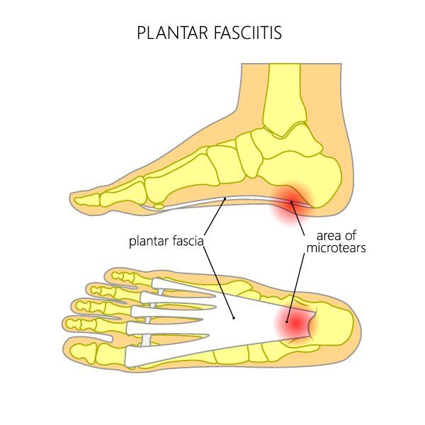 Plantar Fasciitis