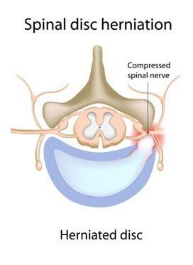 The Benefits of Massage Therapy for Herniated Disc Pain