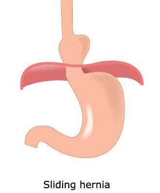 The Health Benefits of Hernia Massage Therapy