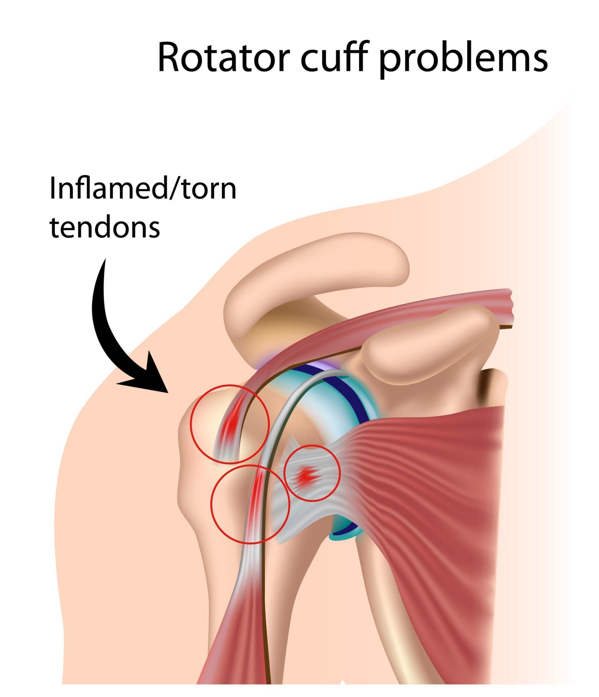Click to Enlarge Rotator Cuff Syndrome Massage Therapist Eugene Wood, Located in Wantagh NY 11793, and Massapequa NY 11758