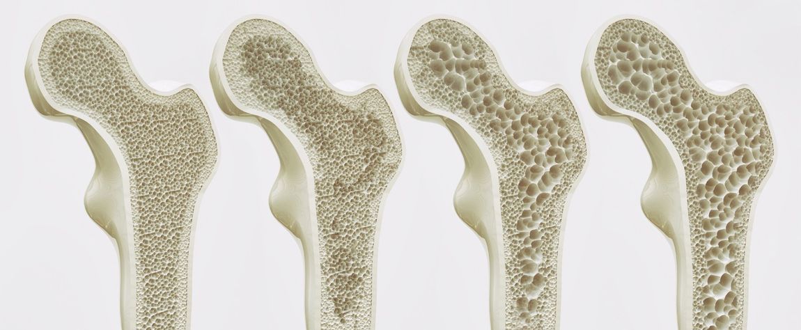 esame osteoporosi a caserta