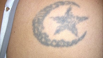 eliminazione tatuaggi