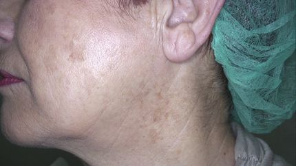 laser vascolare neodimio yag , trattamento angioma- MELANI DOTT.SSA LUCILLA Pistoia