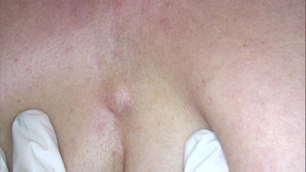 cisti sebacea