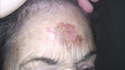 carcinoma cutaneo