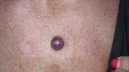 laser vascolare neodimio yag , trattamento angioma- MELANI DOTT.SSA LUCILLA Pistoia
