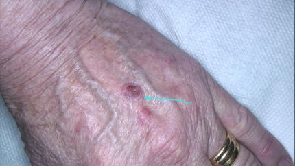 carcinoma cutaneo