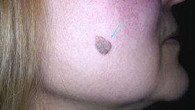 eliminazione tatuaggi