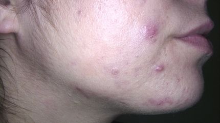 laser vascolare neodimio yag , trattamento angioma- MELANI DOTT.SSA LUCILLA Pistoia