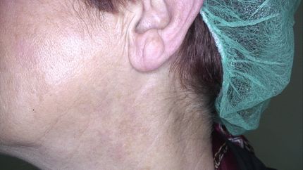 laser vascolare neodimio yag , trattamento angioma- MELANI DOTT.SSA LUCILLA Pistoia