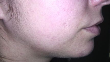 laser vascolare neodimio yag , trattamento angioma- MELANI DOTT.SSA LUCILLA Pistoia