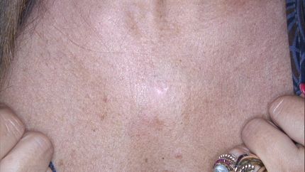 laser vascolare neodimio yag , trattamento angioma- MELANI DOTT.SSA LUCILLA Pistoia