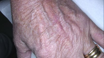 carcinoma cutaneo