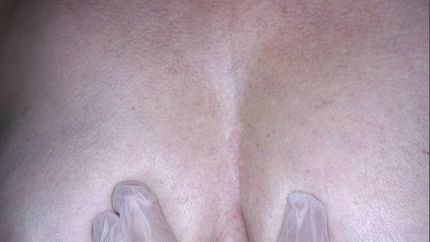 cisti sebacea