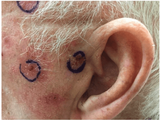 Case of the Month | January | Pine Belt Dermatology