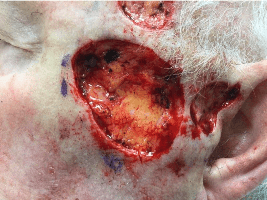 Case of the Month | January | Pine Belt Dermatology