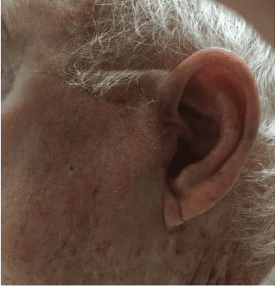 Case of the Month | January | Pine Belt Dermatology