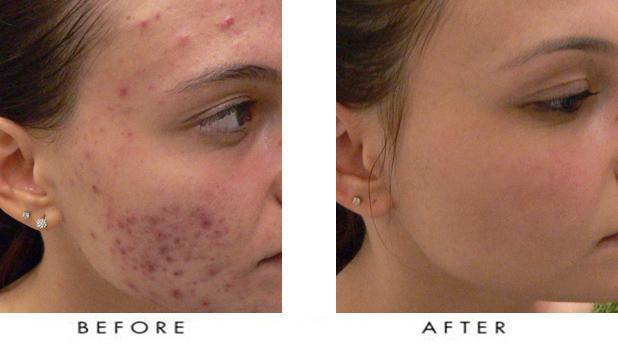 Post-Accutane | Pine Belt Dermatology