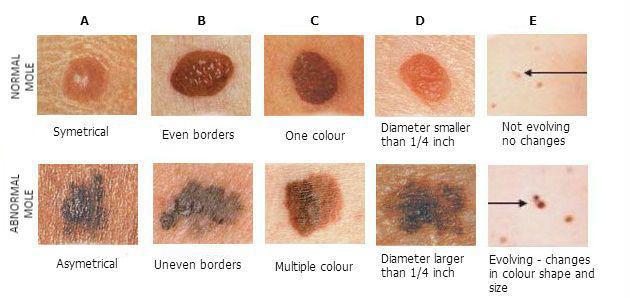 Moles & Melanoma | Pine Belt Dermatology