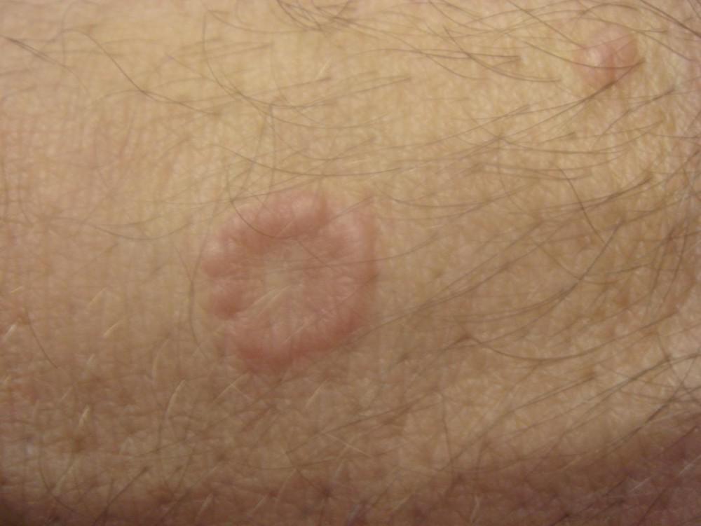 Granuloma Annulare | Pine Belt Dermatology
