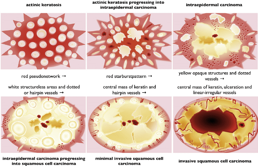 Warts | Pine Belt Dermatology