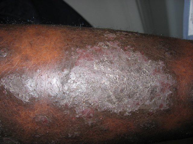 Psoriasis May Differ in Darker Skin | Pine Belt Dermatology