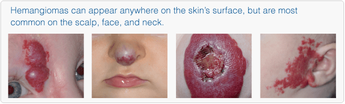 Infantile Hemangiomas | Pine Belt Dermatology