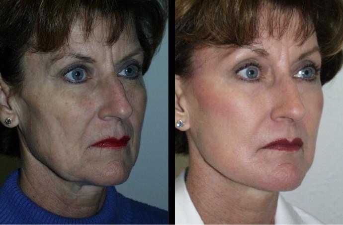 Chemical Peel Procedure | Pine Belt Dermatology
