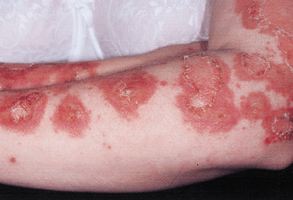 Taming the Wolf | Pine Belt Dermatology