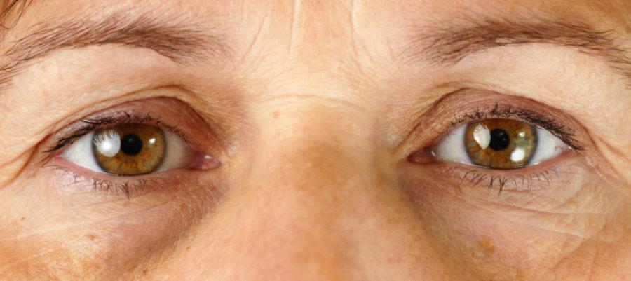 Eye Circles | Pine Belt Dermatology