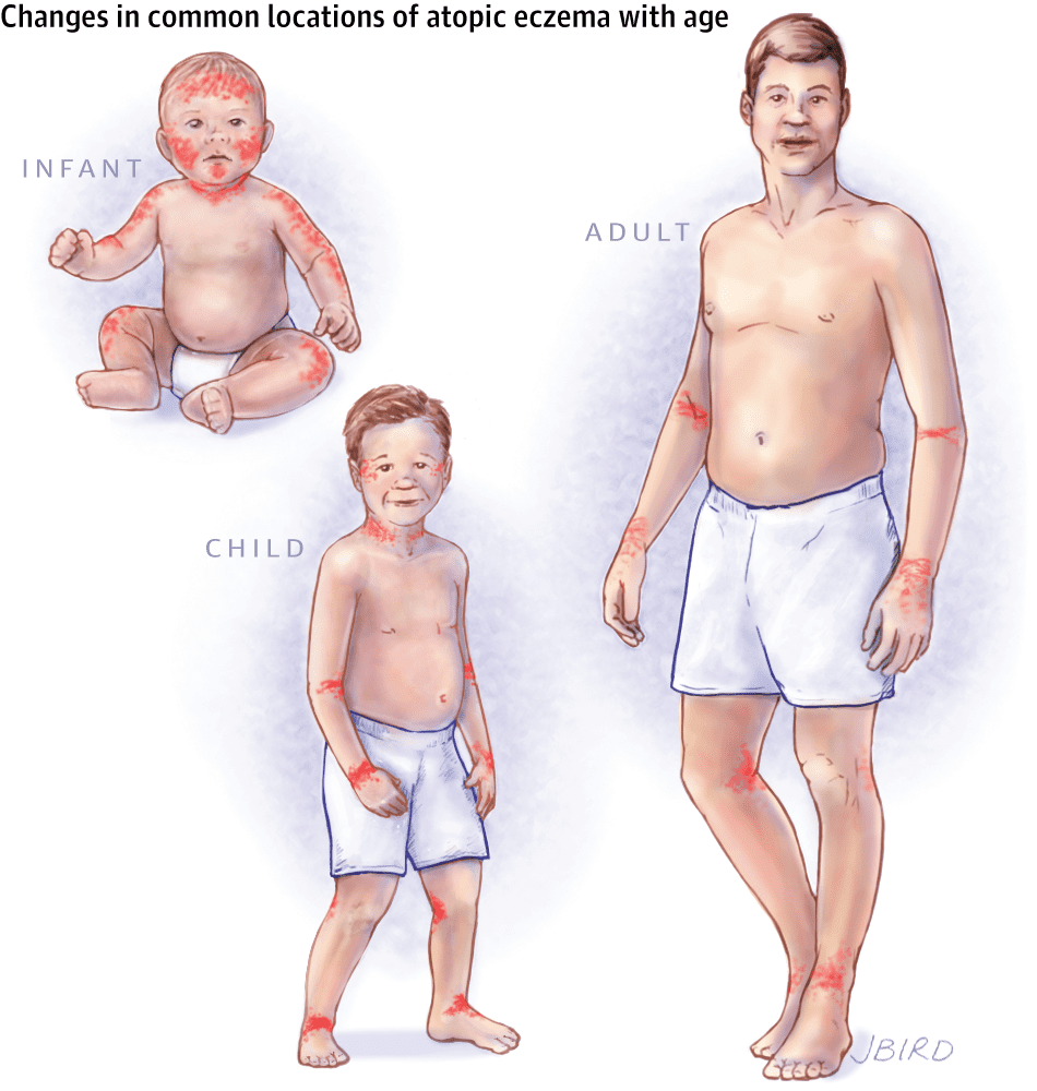 Atopic Dermatitis | Pine Belt Dermatology