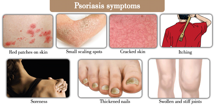 Psoriasis Symptoms Diagram | Pine Belt Dermatology