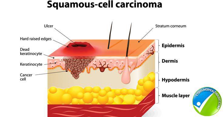 Squamous Cell | What is it | Pine Belt Dermatology